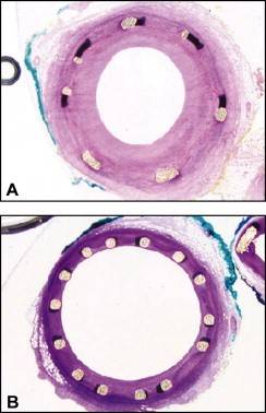 stent-nu.jpg